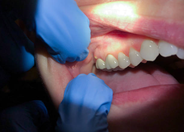 Best Broken or Chipped Tooth Repair in Alpha, NJ